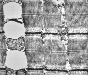 F,32y. | muscular dystrophy - steatosis F,32y. | muscular dystrophy - steatosis